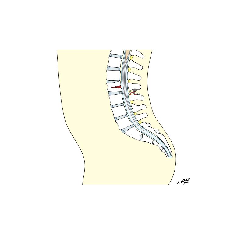 Chance Fracture (flexion-distraction injury)diagnosis and treatment